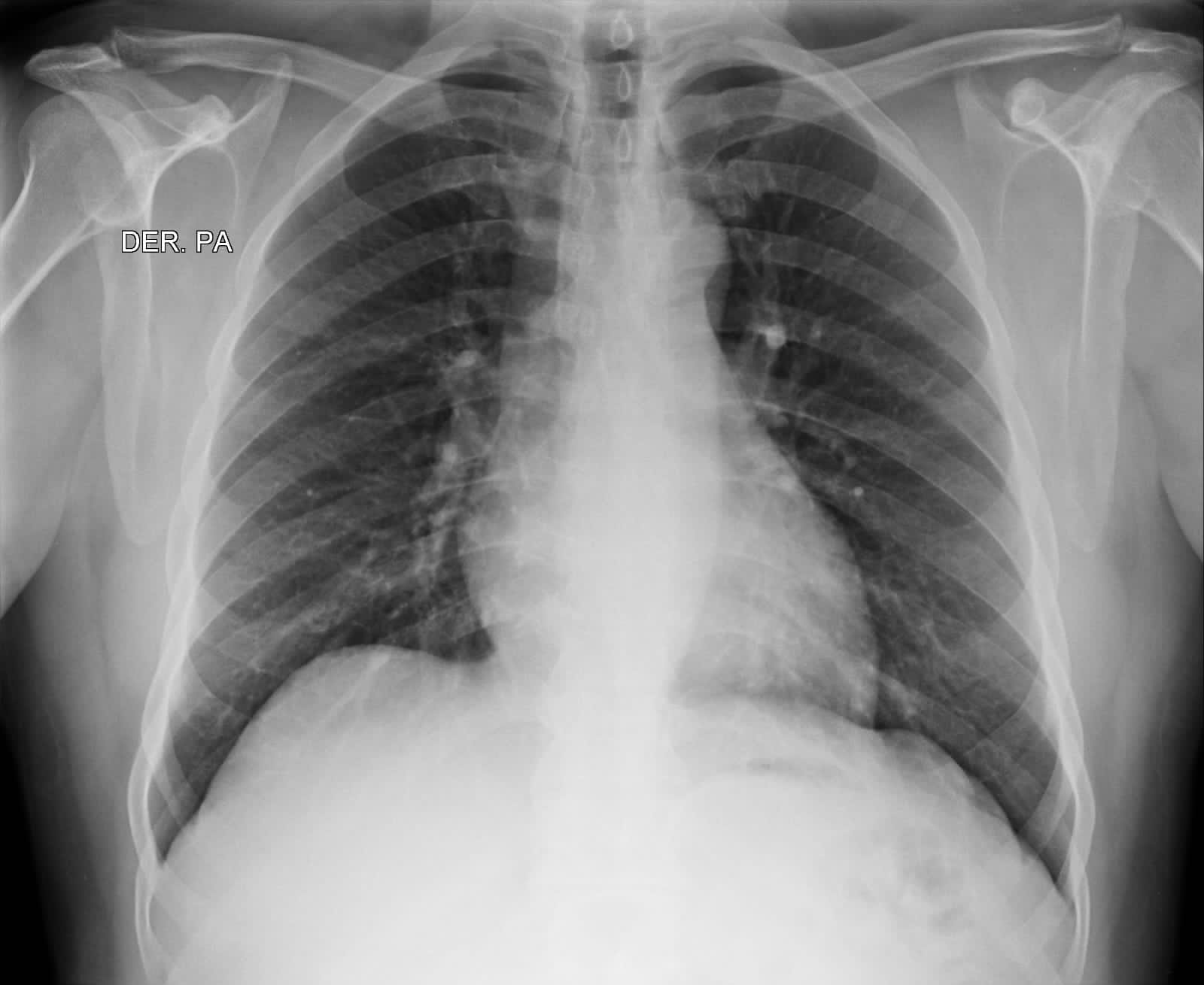 Radiografía de tórax para la salud pulmonar y cardiaca